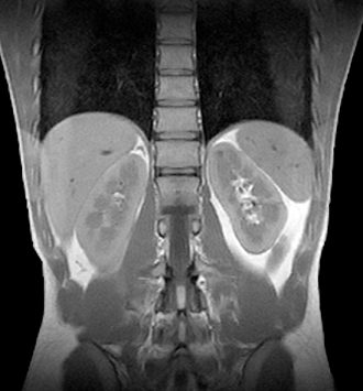 МРТ органов забрюшинного пространства - фото