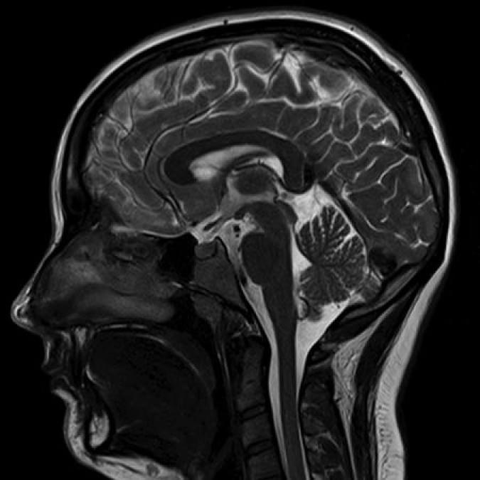 Снимок головного мозга мрт детей
